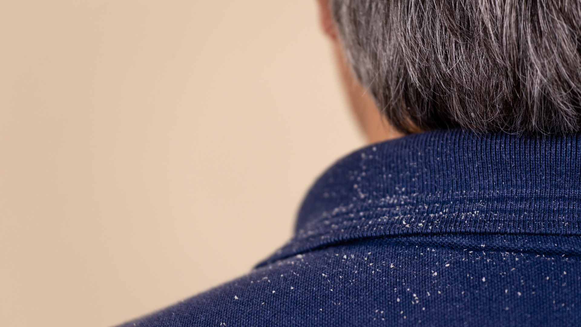 An image of a man in a blue shirt having dandruff.